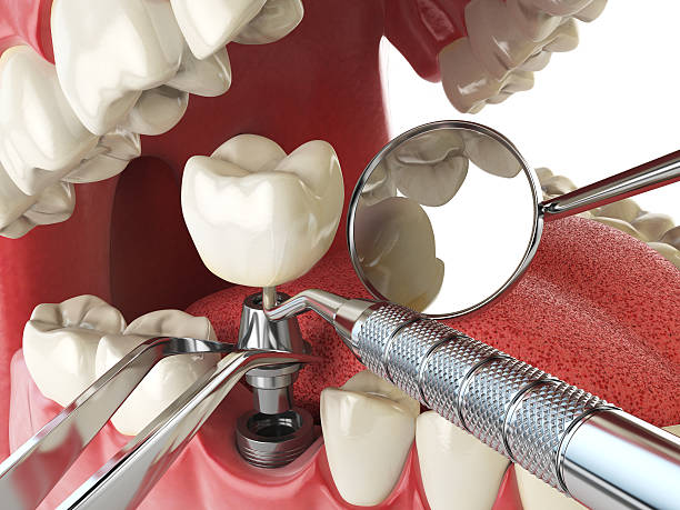 Best Emergency Dentist for Lost Fillings or Crowns in Altamont, NY